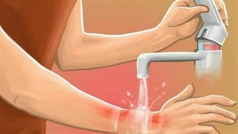 علاج الحروق البسيطة،
