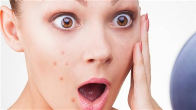 علاج حب الشباب بالمواد الطبيعية وبأقل التكاليف