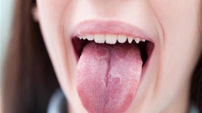 احذر لون لسانك، مؤشر للإصابة بهذا المرض 