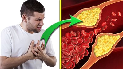 أعراض ارتفاع الكوليسترول، وأهم أسباب الإصابة