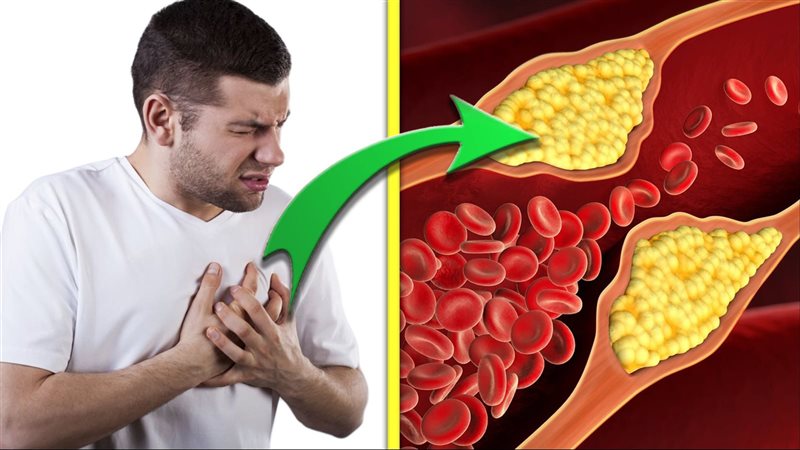 اعراض ارتفاع الكوليسترول،
