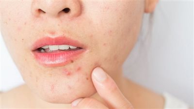 حب الشباب الهرموني، أسبابه وأنواعه وعلاجه بالمنتجات الطبيعية