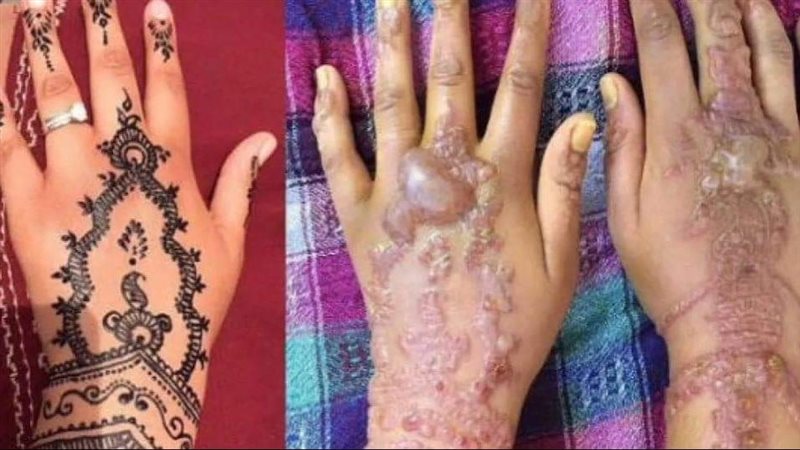 أضرار الحنة، فيتو