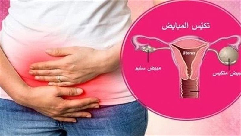 تكيس المبايض، فيتو