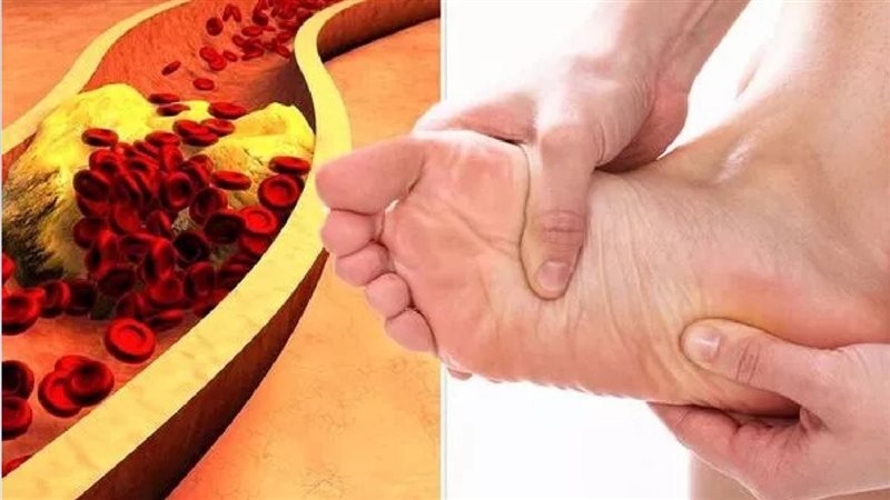 اعراض زيادة الكوليسترول،