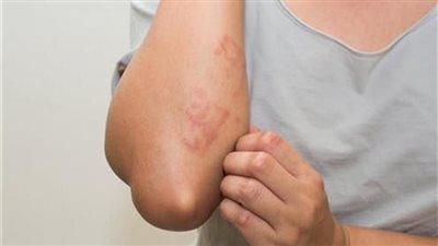 مرض نادر يستهدف الأطفال والشباب، يعود للانتشار، والبداية من أستراليا