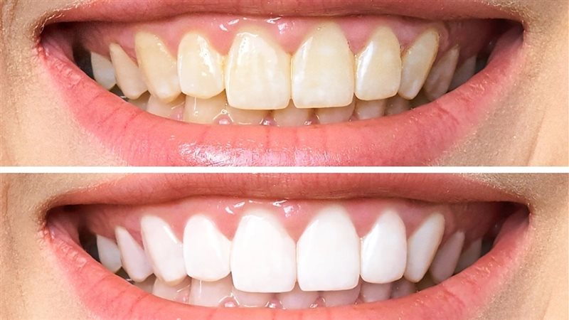 اطعمة تسبب اصفرار
