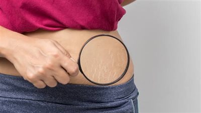 طرق التخلص من علامات تمدد الجلد، بالسكر وزيت شجرة الشاي