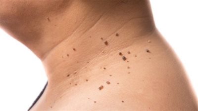 أعراض مقاومة الأنسولين، يجب التنبه لها وعلاجها سريعا 