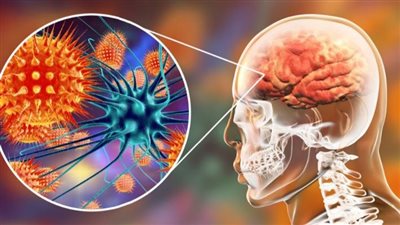 مرض التهاب السحايا، يهدد الأطفال وكبار السن وهذه أهم أعراضه 