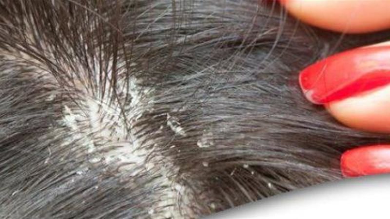 علاج قشرة الرأس،