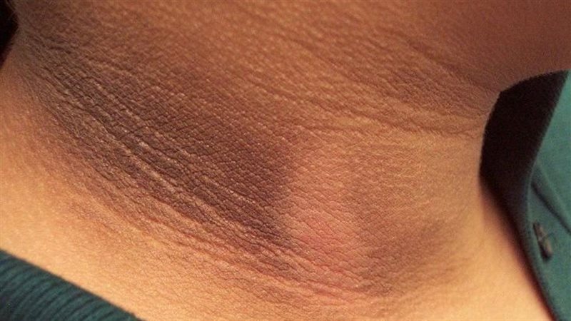 أعراض مقاومة الأنسولين،