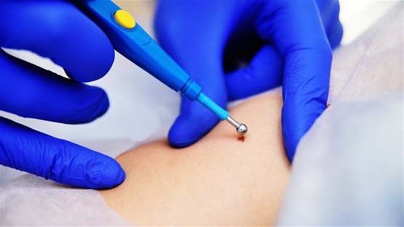 مرض السنط التناسلي،