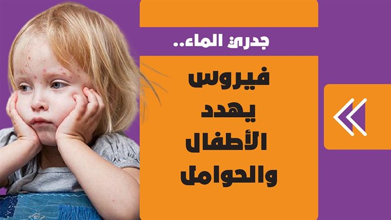 جدري الماء