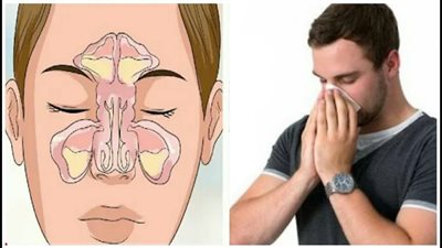 أعراض الجيوب الأنفية، وطرق العلاج بالأعشاب الطبيعية