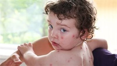 أعراض الجدري عند الأطفال، يجب التعامل بحذر لمنع انتشار العدوى