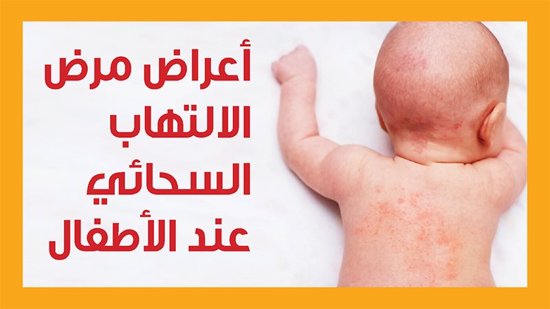 التهاب السحايا، فيتو