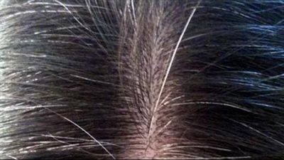 وصفة طبيعية لتطهير فروة الرأس وعلاج تساقط الشعر