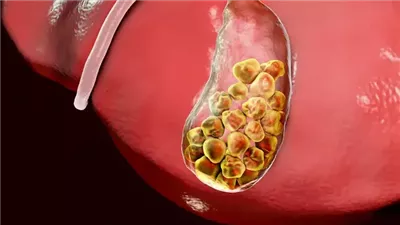 نصائح للحماية من حصوة المرارة وهذه أعراضها