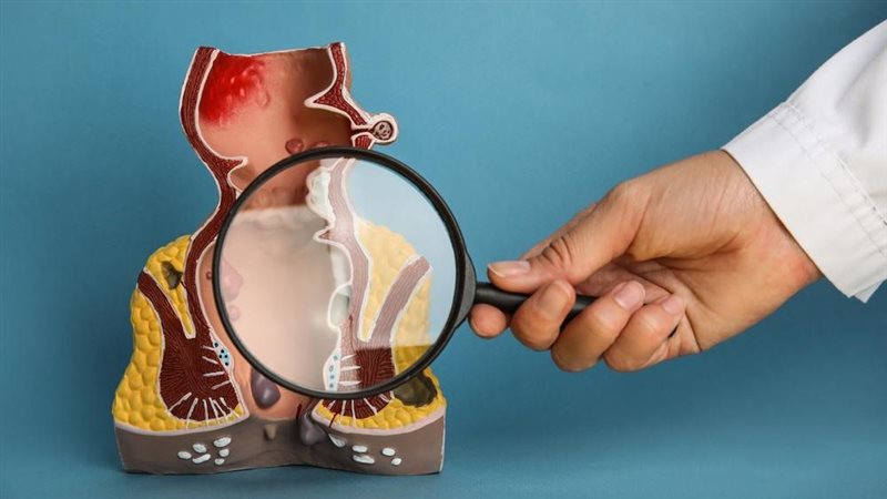 علاج البواسير الخارجية،
