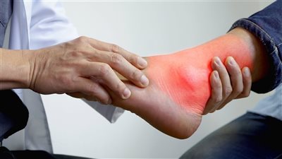 أعراض النقرس، أبرزها آلام ووخز في المفاصل