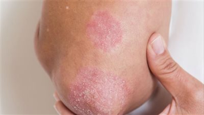 تعرف على مرض الصدفية.. أسباب الإصابة وطرق العلاج