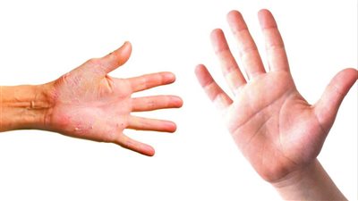  أعراض الجفاف وأسبابه وطرق الوقاية والعلاج