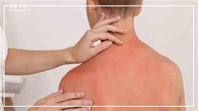 مشكلات صحية خطيرة نتيجة التعرض المفرط للشمس (إنفوجراف)