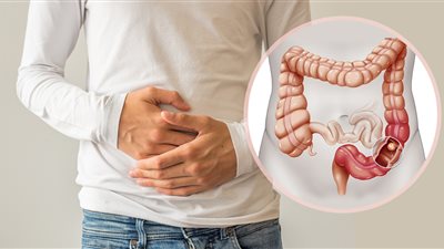 أعراض التهاب القولون، وأسباب الإصابة وعوامل الخطر