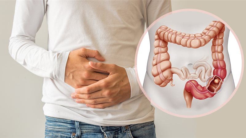 أعراض التهاب القولون،