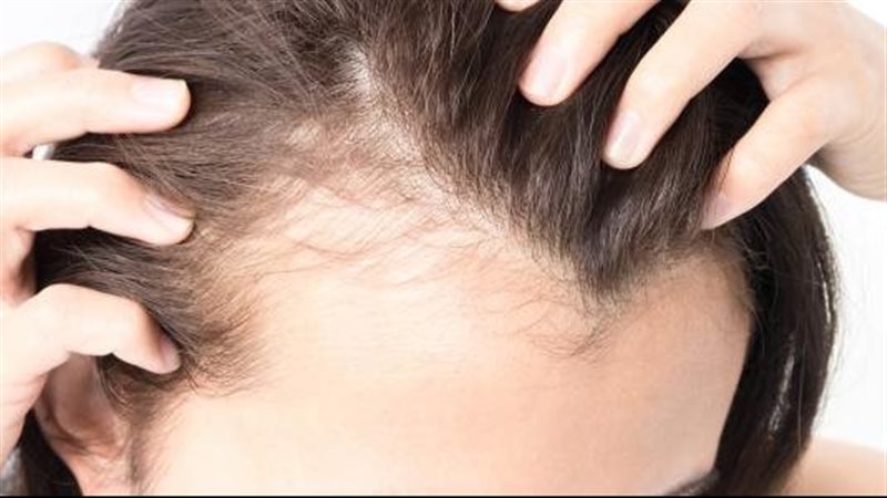 علاج فراغات الشعر،