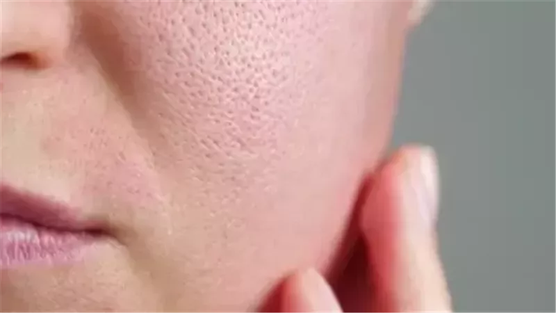 المسام الواسعة، فيتو