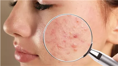 قناع الزبادي والكركم استخدميه يوميا في الصيف للوقاية من الحبوب 
