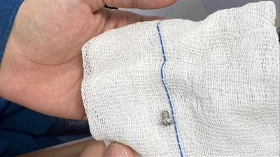 إنقاذ حياة كهربائي ابتلع مسمار واستقر بالقصبة الهوائية ببنها الجامعي
