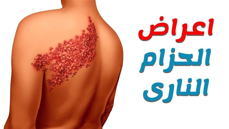 اعراض الحزام الناري