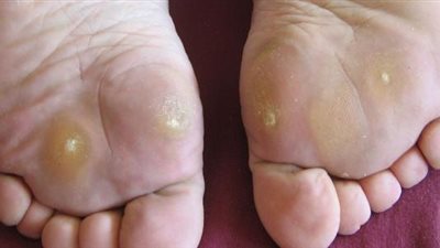 أسباب عين السمكة وأعراضها ومخاطرها وطرق العلاج والوقاية 