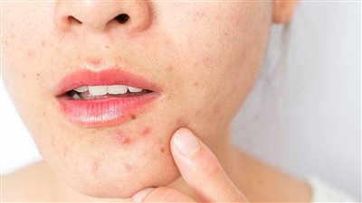 قناع العسل والقرفة لعلاج حب الشباب سريعا 
