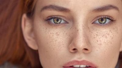 موجودة في مطبخك، ماسكات طبيعية للتخلص من النمش