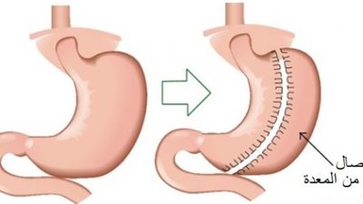 أول تعليق لطبيب أجرى عملية تكميم المعدة لطفلة عمرها 9 سنوات