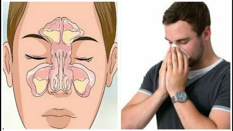 الجيوب الأنفية وعلاجها