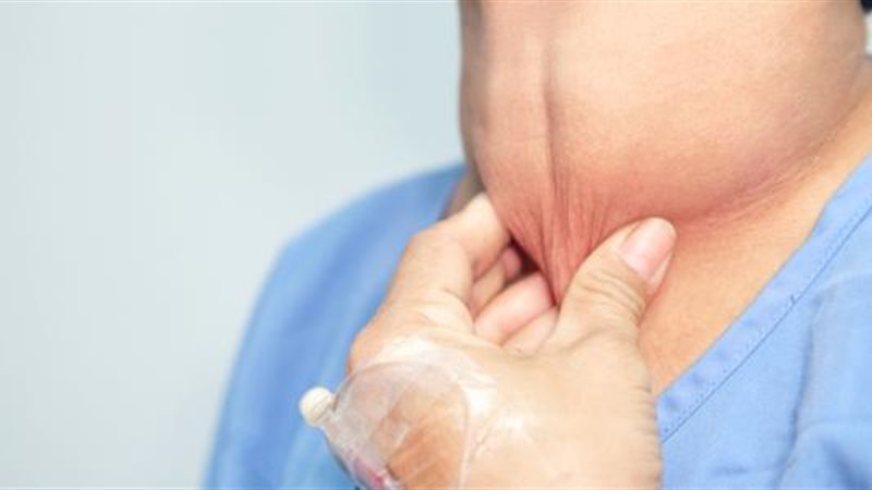 سرطان الغدة الدرقية،