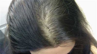 وصفة طبيعية لملء فراغات الشعر وإعادة جماله وكثافته 