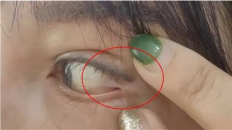 بعملية تجميلية عين