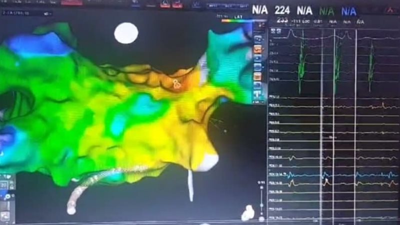 علاج مرضى الذبذبة