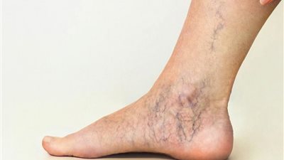 وصفات طبيعية للتخلص من دوالي الساقين بشكل نهائي 