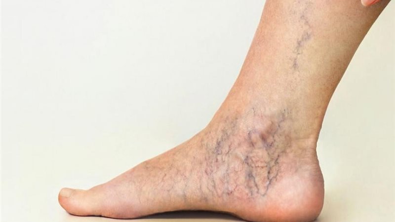 طرق طبيعية لعلاج