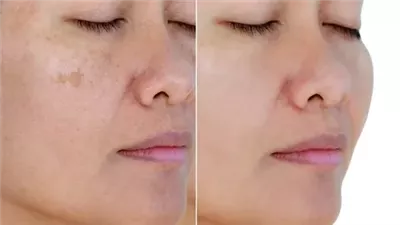 قناع طبيعي يقضى على البقع الداكنة بالبشرة 