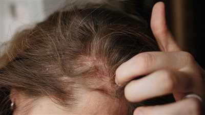 وصفة طبيعية لعلاج حكة والتهابات فروة الرأس 