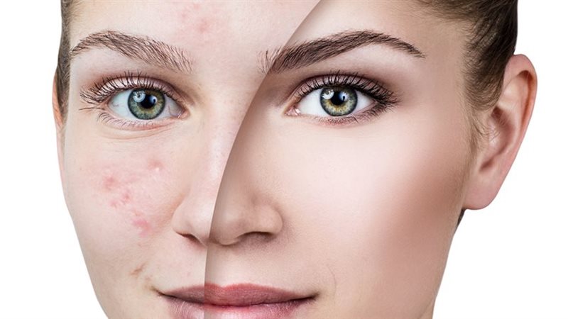 علاج حب الشباب وآثاره
