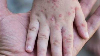 هل يتم تعطيل الدراسة بالمنوفية بعد انتشار الجدري المائي؟ وكيل التعليم يجيب (فيديو)